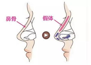 合肥假體隆鼻注意事項是什么