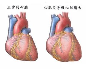心臟擴張注意事項