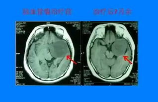 腦血管瘤注意事項