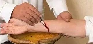 刺血療法禁忌癥與注意事項