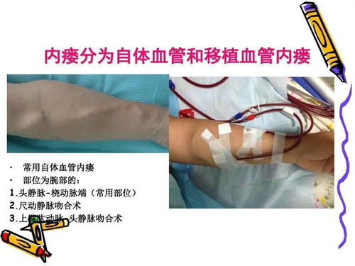 動(dòng)靜脈瘺護理注意事項