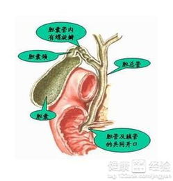 膽結石,注意事項,發(fā)生