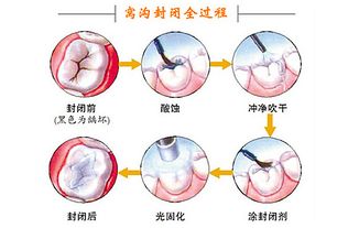 牙齒做封閉后注意事項,牙齒根管治療后注意事項,洗完牙齒后的注意事項