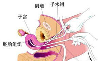 刮宮之后的注意事項,無(wú)痛刮宮前注意事項,刮宮手術(shù)后注意事項
