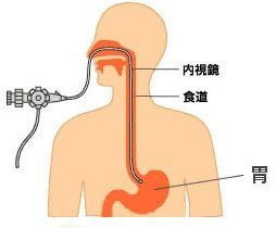 腸鏡胃鏡檢查后飲食注意事項,無(wú)痛胃鏡檢查后飲食注意事項有哪些方面,胃鏡檢查后飲食需要注意事項