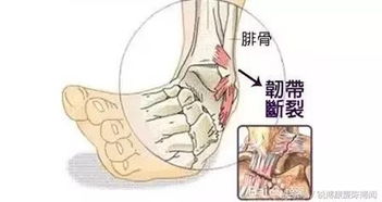 韌帶提拉手術(shù)后的注意事項