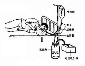 注意事項,插管