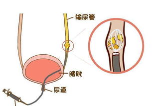 輸尿管插管后注意事項