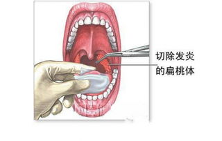 扁桃體摘除手術(shù)后注意事項