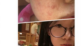 臉部過敏發(fā)注意事項(xiàng)