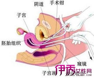 無(wú)痛刮宮之后注意事項