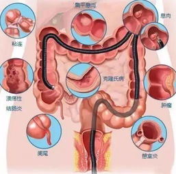 腸鏡檢查準備注意事項