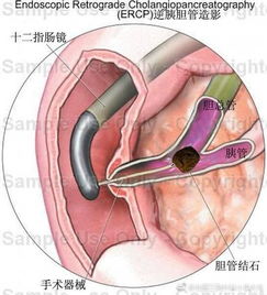 ercp檢查術(shù)后注意事項