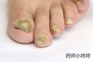 真菌感染口腔護理注意事項,耳朵真菌感染注意事項,關(guān)于真菌感染治療的注意事項