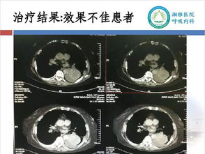 胸腔熱灌注的注意事項,恩度胸腔灌注注意事項,胸腔灌注化療注意事項
