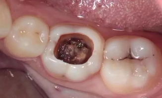 補(bǔ)牙,拔牙,注意事項(xiàng)