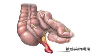 闌尾炎術(shù)后注意事項,闌尾炎注意事項和飲食,預防闌尾炎注意事項