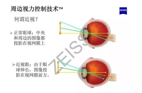 近視鏡片的基礎知識