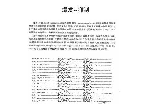 小兒腦電圖基礎知識課件